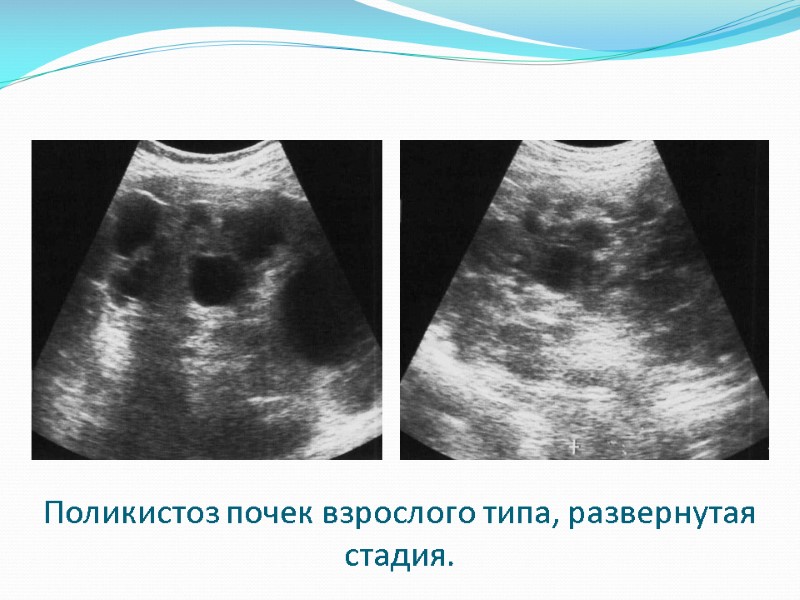 Поликистоз почек взрослого типа, развернутая стадия.